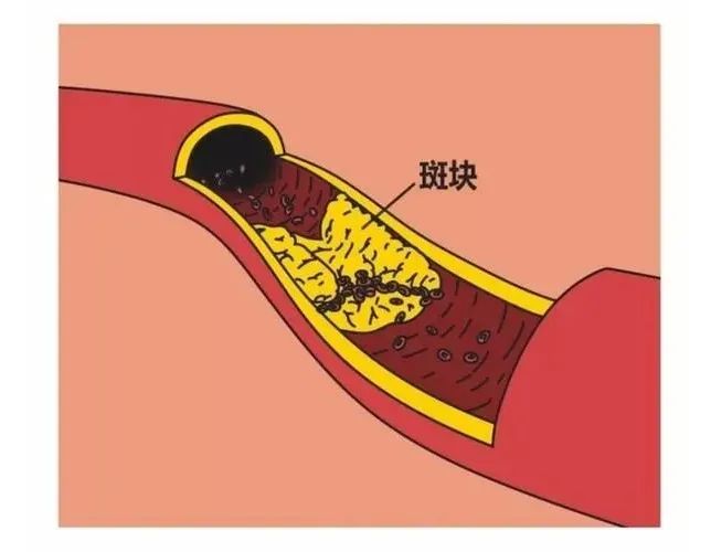 健康科普丨每個(gè)人都有動(dòng)脈斑塊？到底該怎么治療？