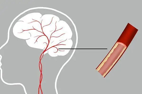 提醒中老年人：腦供血不足時(shí)，身體會(huì)發(fā)出4個(gè)信號(hào)！該如何治療？