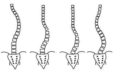 脊柱側(cè)彎如何康復(fù)？河南省中醫(yī)院西區(qū)醫(yī)院專家這樣說