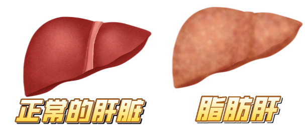 健康科普 從脂肪肝到肝癌的預(yù)防，這些肝臟疾病風(fēng)險(xiǎn)篩查一定要做哦！