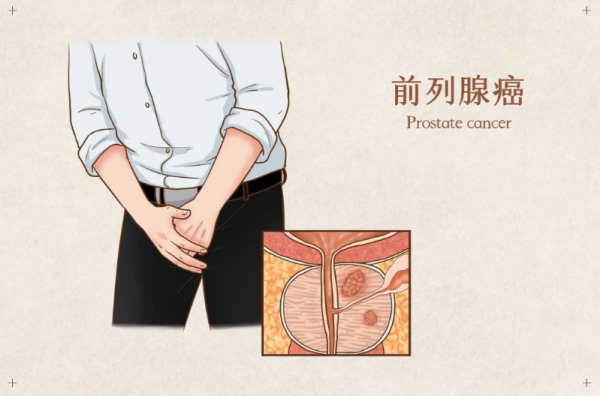 前列腺癌一發(fā)現(xiàn)就是晚期？注意這4個方面，遠離它！