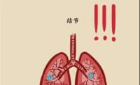 2 毫米肺結(jié)節(jié) 3 年后變肺癌！醫(yī)生提醒：這 2 種肺結(jié)節(jié)一定要當(dāng)心！