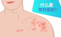 這種病不致命，疼起來卻要人命！關(guān)注帶狀皰疹，及早預(yù)防……