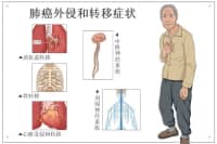 腿疼被診斷為肺癌晚期？腿上出現(xiàn)這4種現(xiàn)象，千萬要注意！